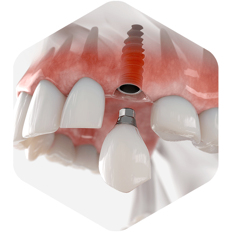 3D illustration of a dental implant with its crown.